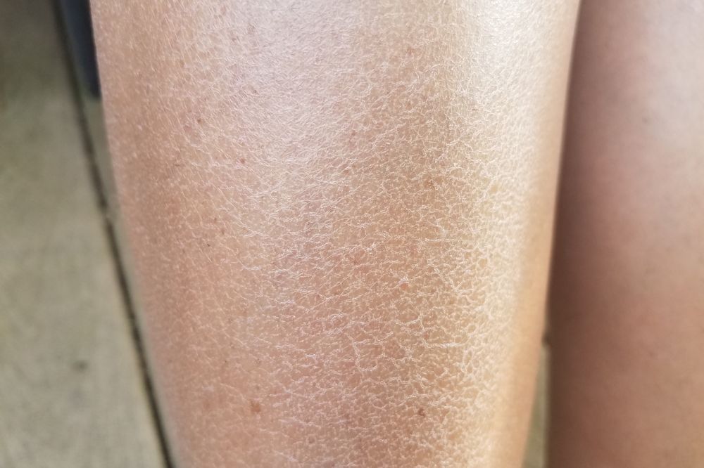 Why your Skin Feels Dry Again By Midday In Winter